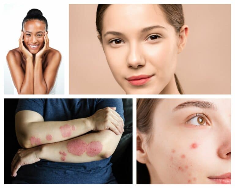 Four photos of how w a healthy gut can impact your skin. two photos show people with radiant skin and the other two photos show people with acne and eczema